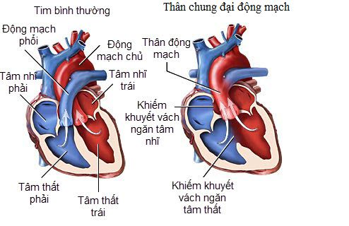 Thân chung động mạch