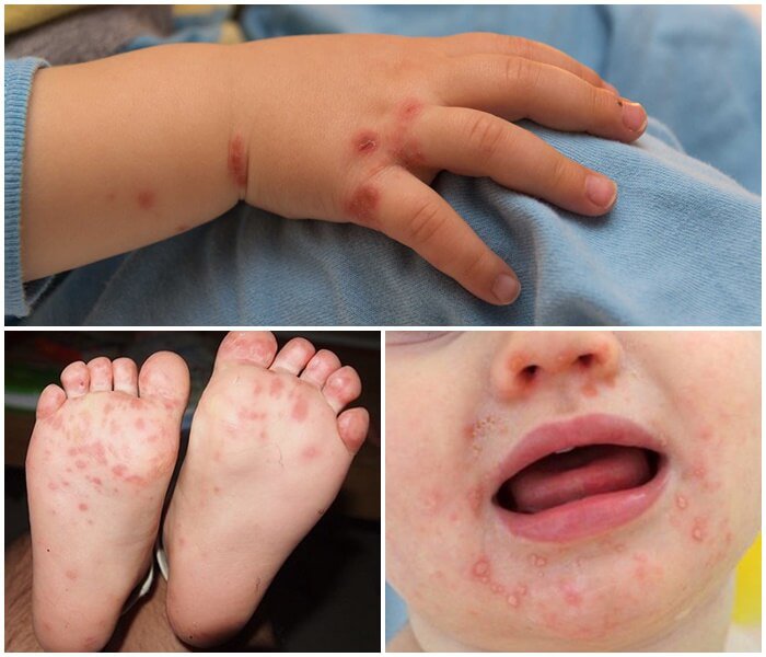 Bệnh tay chân miệng- Phải làm sao?Bệnh tay chân miệng- Phải làm sao?